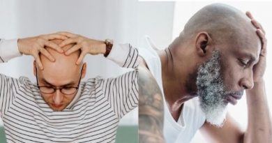 men heads bald